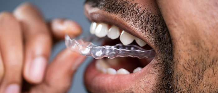 „Unsichtbare“ Zahnspangen in Datteln