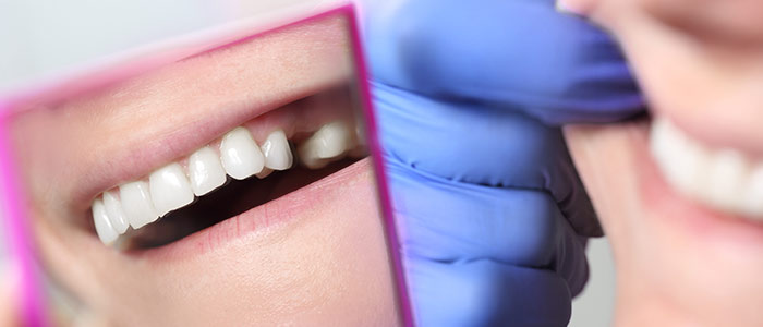 Zahnkorrektur vor Brücke, Implantat in Datteln